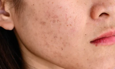 Mengatasi Kulit Kusam dan Jerawat di Musim Panas