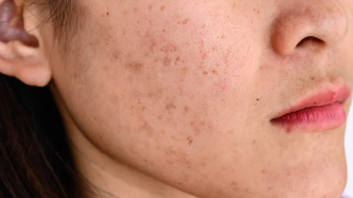 Mengatasi Kulit Kusam dan Jerawat di Musim Panas