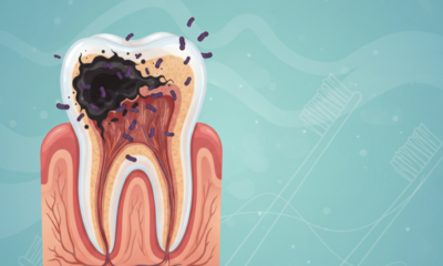 ilustrasi gambar gigi berlubang