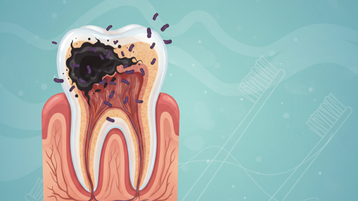 ilustrasi gambar gigi berlubang