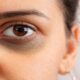 Waspada! Raccoon Eyes Tanda Medis Serius yang Harus Diketahui 53 WhatsApp Image 2026 08 21 at 07.43.21 1 1