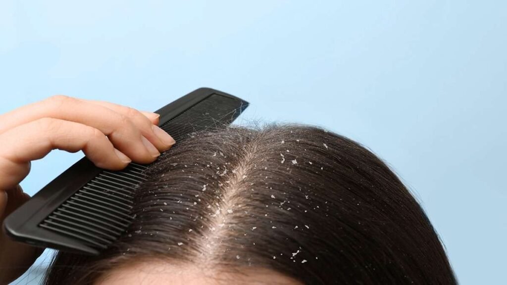 Seseorang menyisir rambut hitam yang mengalami ketombe dan serpihan putih di kulit kepala