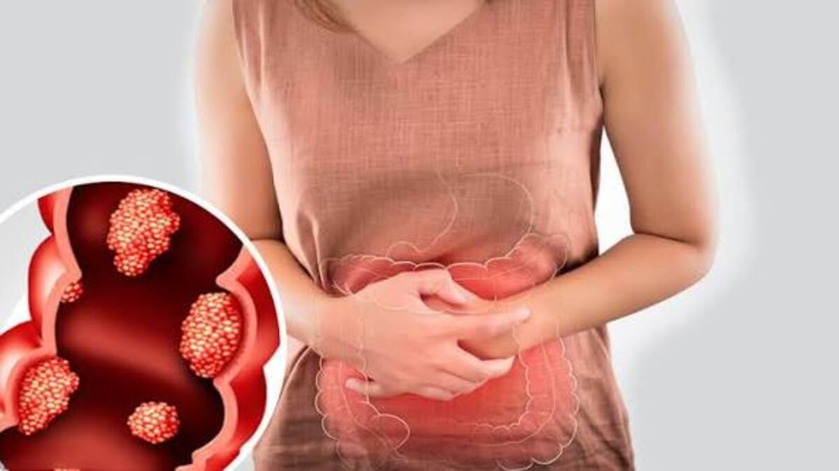 Mengerikan! Fenomena Kanker Usus Besar Anak Muda Kian Meningkat, Waspadai 4 Tanda Ini 51 images 2026 08 20T175610.535 1