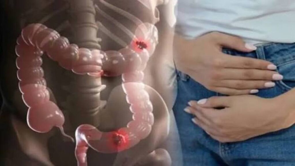 Mengerikan! Fenomena Kanker Usus Besar Anak Muda Kian Meningkat, Waspadai 4 Tanda Ini 52 images 2026 08 20T175618.100