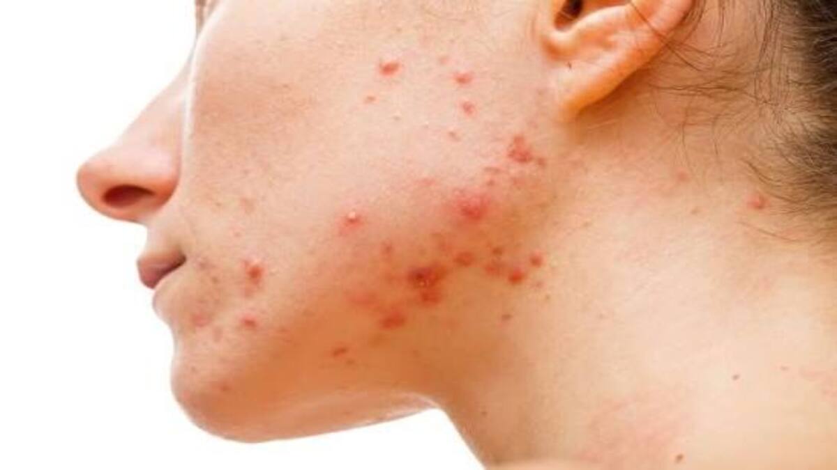 7 Cara Mengatasi Jerawat Hormonal di Rahang Ampuh dan Tuntas 52 IMG 1402